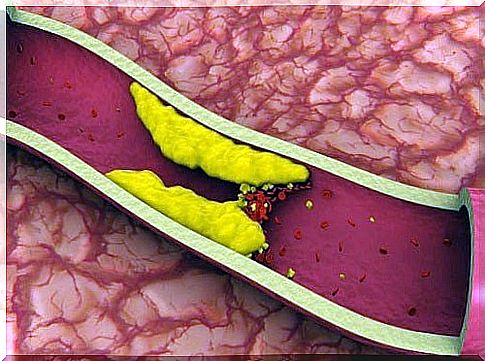 10 Foods to Clean Arteries and Prevent Atherosclerosis