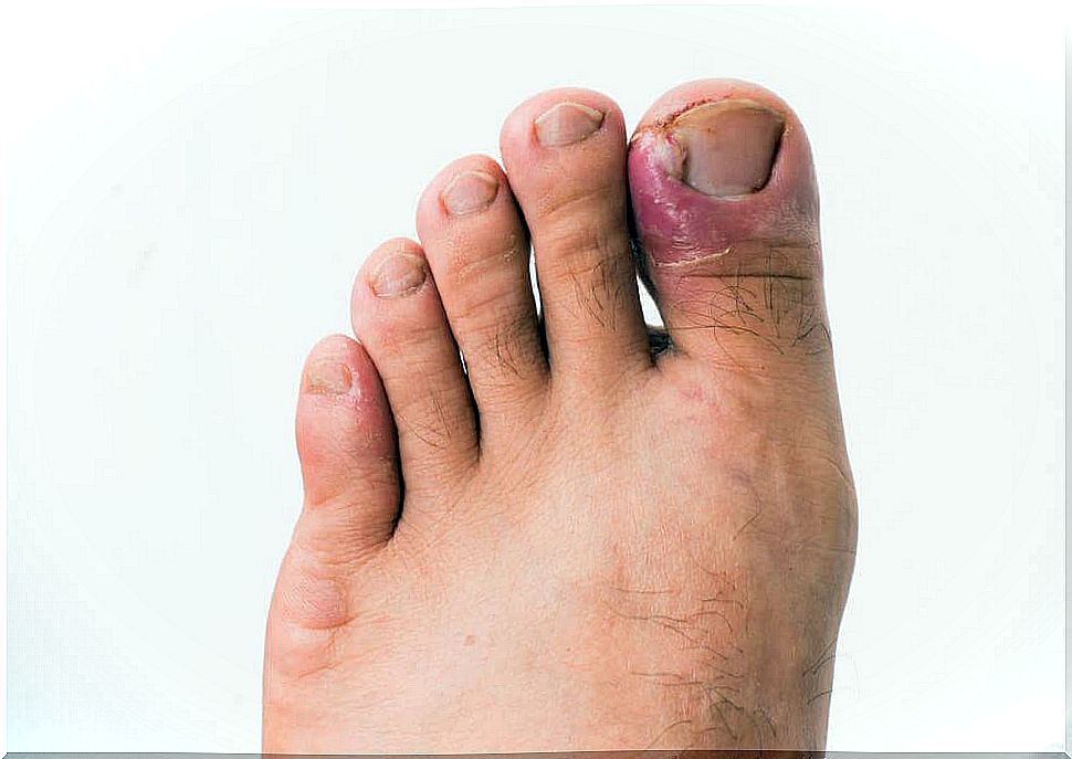 Ingrown toenail infection in the big toe