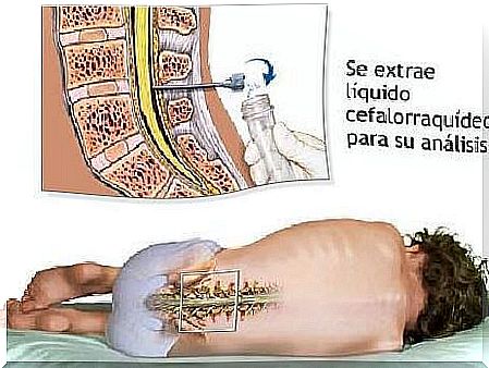 Lumbar puncture to detect brain tumor