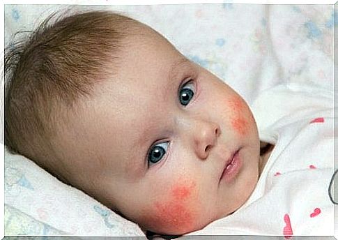 baby with dermatitis