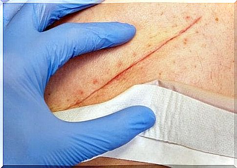 Basic techniques for closing wounds