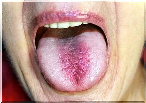 Burning Mouth Syndrome