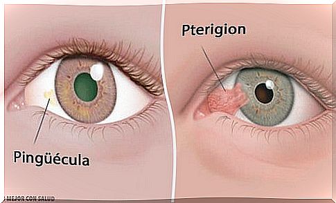 Corneal tumors: pinguecula and pterygium