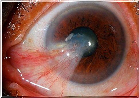 Similarities between the pinguécula and the pterygium