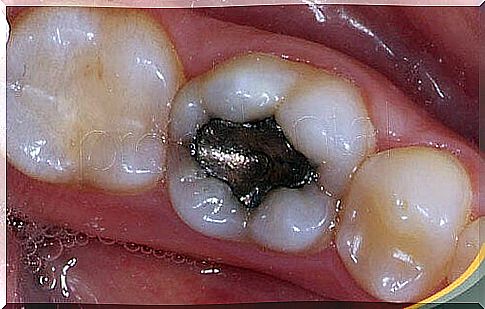 Health risks of amalgam fillings