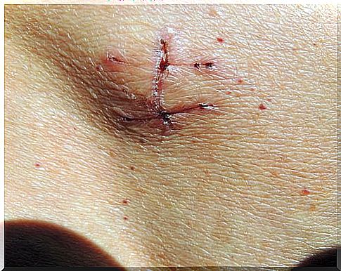 Inguinal hernia surgery scar