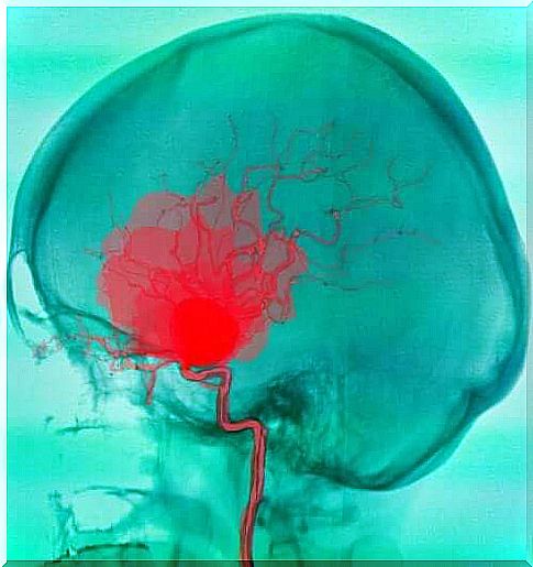 Subdural or subarachnoid hemorrhage