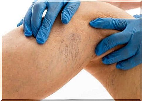 woman with varicose veins