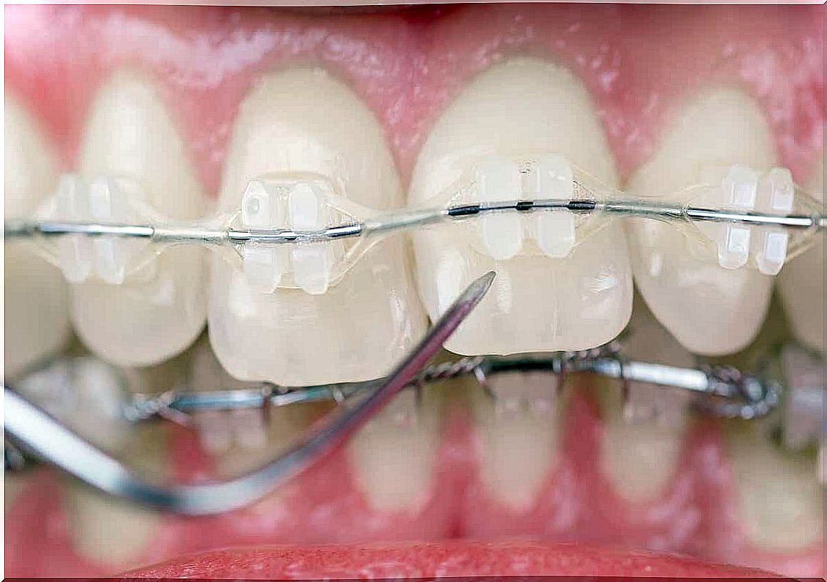 Is it possible to prevent the development of an overbite?