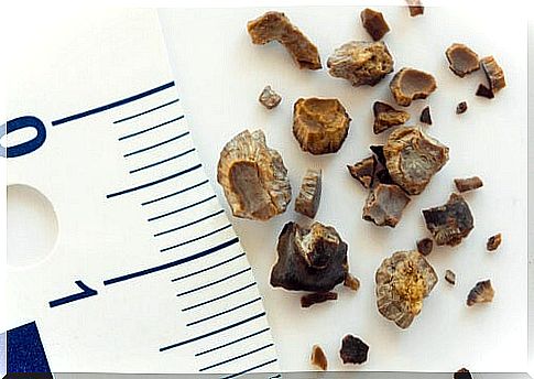 Kidney stones-by-urine retention